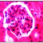 Figure 4: Renal tissues after three week of iron supplementation showing iron accumulation in cytoplasm and nearly normal glomeruli (G) X750.