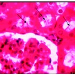 Figure 5:  After one week of well fed with iron supplementation the renal lumina were occupied by cellular casts (Ø) and hyaline materisl with disrupted brush border X750.