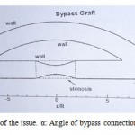 Figure 1- The geometry of the issue. α: Angle of bypass connection. β: The main vain angle