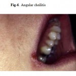 Figure 6: Angular cheilitis.