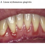 Figure 1: Linear erythematous gingivitis.