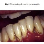 Figure 2: Necrotizing ulcerative periodontitis.