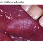 Figure 3: Oral hairy leukoplakia.