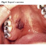 Figure 4: Kaposi’s sarcoma.