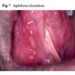 Figure 7: Aphthous ulceration.