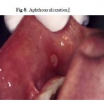 Figure 8: Aphthous ulceration.