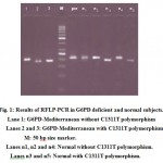 Figure 1: Results of RFLP-PCR in G6PD deficient and normal subjects.