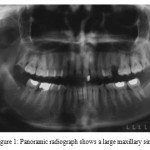 Figure 1: Panoramic radiograph shows a large maxillary sinus.