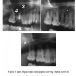 Figure 2: parts of panoramic radiographs showing relation scores to the maxillary sinus floor from 0 -4.