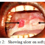Figure 2: Showing ulcer on soft palate.