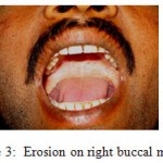 Figure 3: Erosion on right buccal mucous.