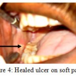 Figure 4: Healed ulcer on soft palate.