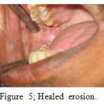 Figure 5: Healed erosion. 