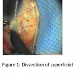 Figure 1: Dissection of superficial scleral flap.