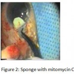 Figure 2: Sponge with mitomycin C.