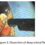 Figure 3: Dissection of deep scleral flap.