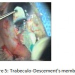 Figure 5: Trabeculo-Descement's membrane.