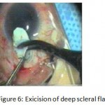 Figure 6: Exicision of deep scleral flap.