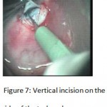 Figure 7: Vertical incision on the side of the trabeculum.