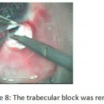 Figure 8: The trabecular block was removed.