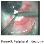 Figure 9: Peripheral iridectomy.
