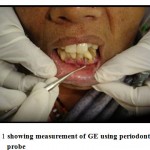 Figure 1: showing measurement of GE using periodontal probe.