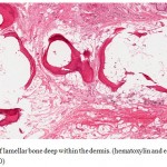 Figure 2: Rings of lamellar bone deep within the dermis. (hematoxylin and eosin, original magnification X20).