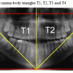 Figure 2: Shows the ramus-body triangles T1, T2, T3 and T4: