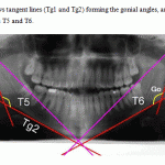 Figure 3: Shows tangent lines (Tg1 and Tg2) forming the gonial angles, and the ramus-body triangles T5 and T6.