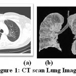  Figure 1: CT scan Lung Image