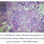 Figure 2: Histological image. Adenomyoma of jejunum, smooth muscle bundles between dilated and cystic exocrine type cysts. low power ( ×100), H&E stained.