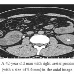 Figure 1: A 42-year old man with right ureter proximal stone (with a size of 9.6 mm) in the axial image.