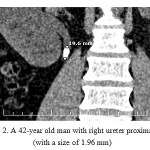 Figure 2: A 42-year old man with right ureter proximal stone (with a size of 1.96 mm).