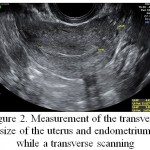 Figure 2: Measurement of the transverse size of the uterus and endometrium while a transverse scanning