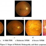 Figure 2: Stages of Diabetic Retinopathy and their symptoms