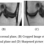 Figure 6a: Noise sifted picture of coronal plane, (B) Cropped Image of coronal plane, (c) Resize of trimmed picture 1.5 times in coronal plane and (D) Sharpened picture of coronal plane