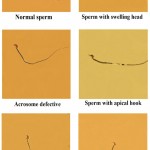 Figure 2: The normal sperm and different forms of abnormalities in the sperm head of mice treated with methandienone (40X).