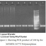 Figure 1: Showing PCR product of 198 bp for MTHFR C677T Polymorphism.