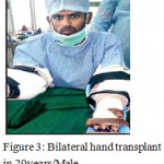 Figure 3: Bilateral hand transplant in 29years/Male.