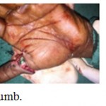 Figure 4: Reimplantation of Thumb.