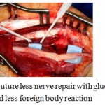 Figure 5: Suture less nerve repair with glue is simple, quicker and less foreign body reaction.