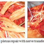 Figure 6: Brachial plexus repair with nerve transfer procedure.