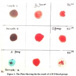 Figure 1: The Plate Showing the the result of A B O blood groups